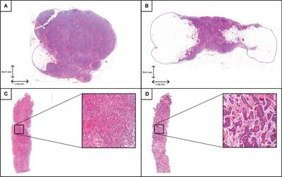 The prognostic value of the histological shape of tumor negative sentinel nodes in breast cancer